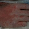 24 Year old male in early stage of Toxic Epidermal Necrolysis Syndrome with severe Ocular involvement. Approximately 4 days into reaction. (5)
